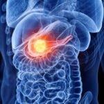 Pancreatic Cancer