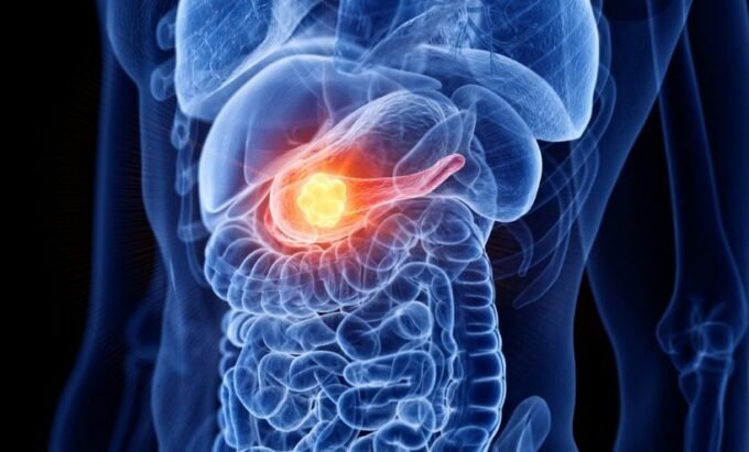 Pancreatic Cancer